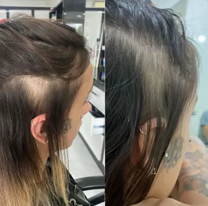 case-tratamento-alopecia-moca-1.webp