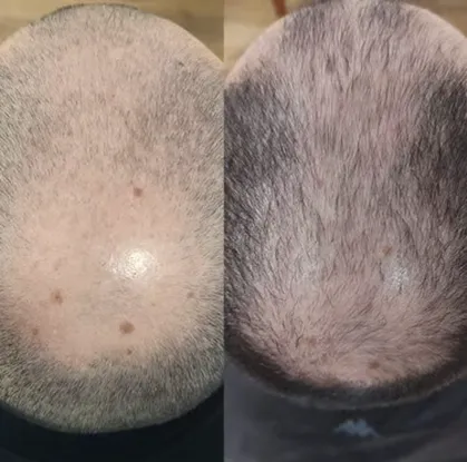 case-tratamento-alopecia-rapaz-1.webp